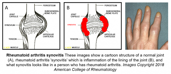 StopRA | Rheumatoid Arthritis Prevention Study